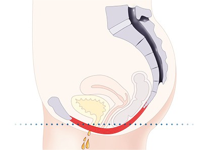 Pelvic-Floor Muscle Repair 5 Pelvic floor muscles Thurrock Park