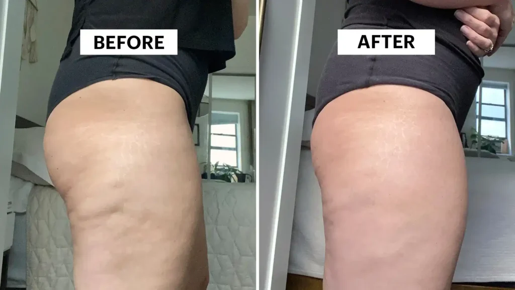 Sculpting Your Bum: Can Toning Exercises Really Reduce Cellulite? 1 Do Toning Exercise Thurrock Park Really Tackle Cellulite?