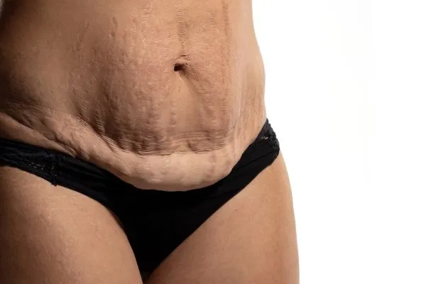 The science behind skin tightening Thurrock Park picture of a woman's sagging skin on the stomach